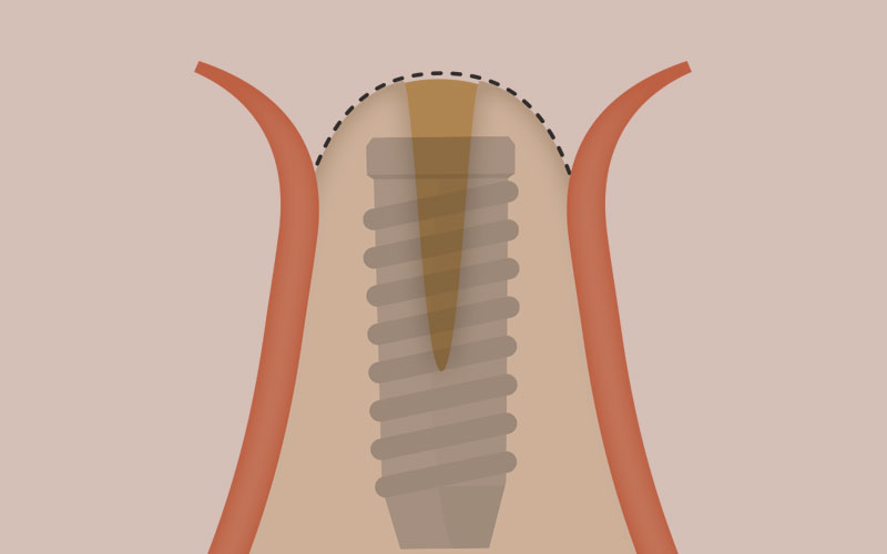 スプリットクレスト